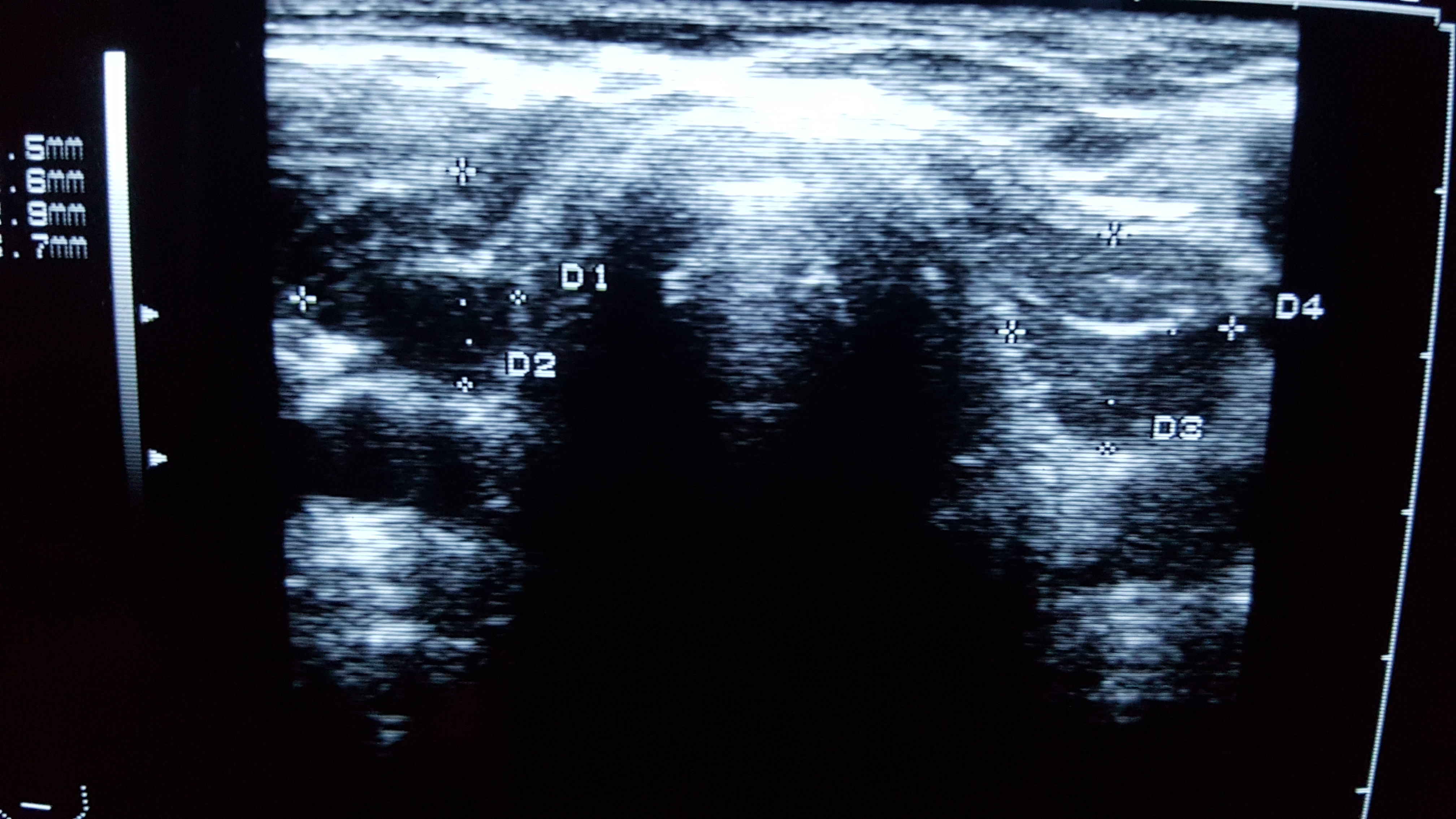 Tiroide di paziente di 48 anni in ipotiroidismo da sunitinib